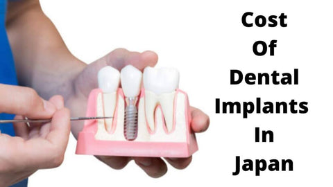 Cost Of Dental Implants In Japan (1)